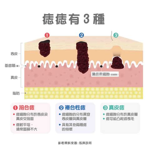 為甚麼會長痣|痣變大、痣多或長毛會變皮膚癌？認識痣的形成與原因